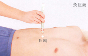 冠心病艾灸