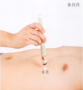 胆石症艾灸