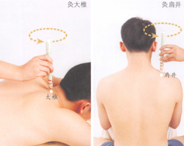 落枕艾灸