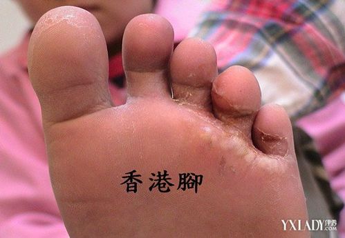 香港脚怎么治最好最快，治疗香港脚的偏方