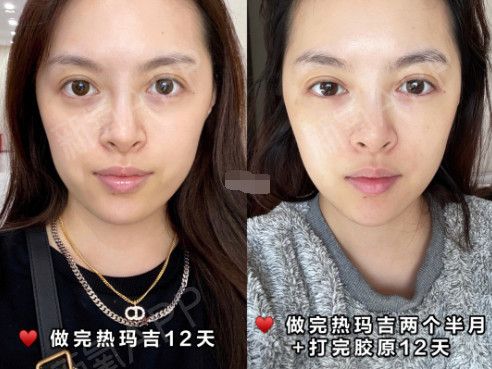 热玛吉做完老得更快热玛吉效果和后遗症