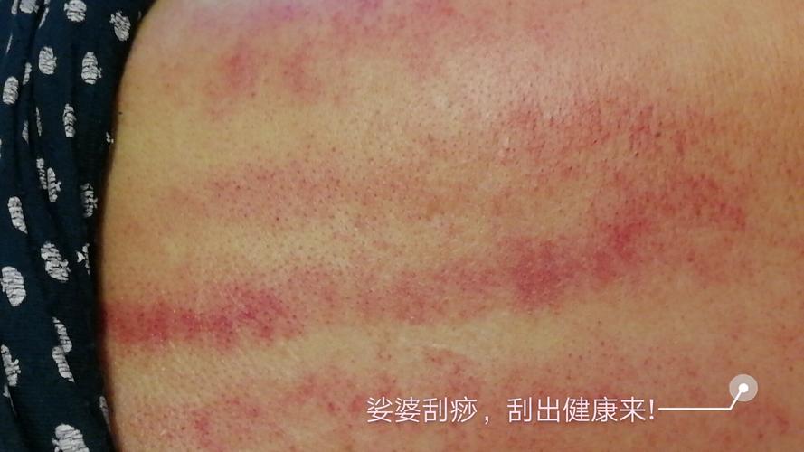 调理亚健康　刮痧帮助你