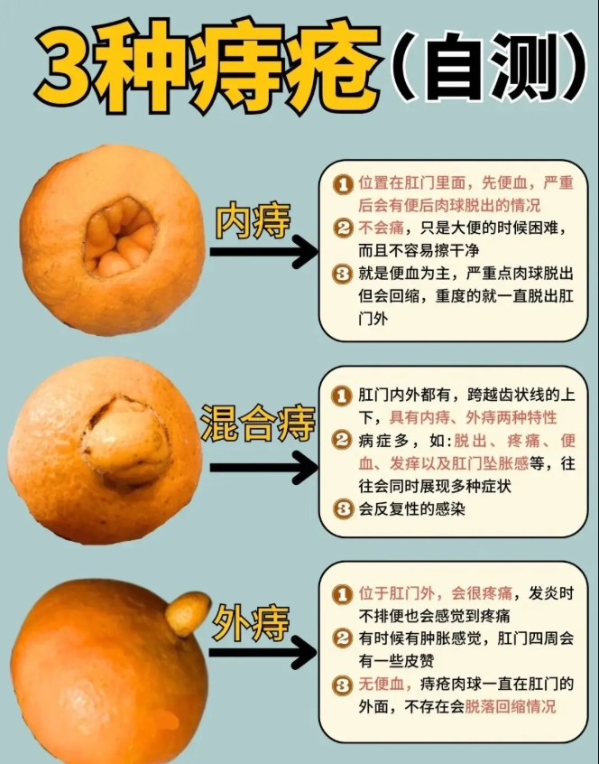痔疮.jpg