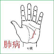 健康线索索连连是肺病