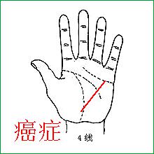 健康线拉直变粗是癌症，切蹉大线脏尤心