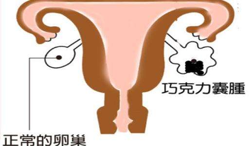 巧克力囊肿 www.zgmjyxw.com