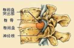 腰椎间盘突出