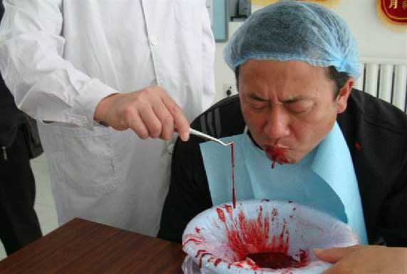 放血疗法