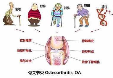 膝关节疼痛选穴一针疗法