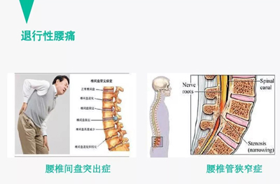 腰痛的针灸治疗