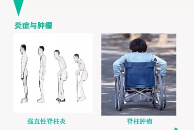 腰痛的针灸治疗