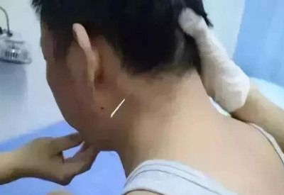 完骨