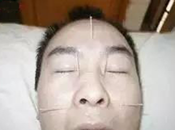 鼻三针