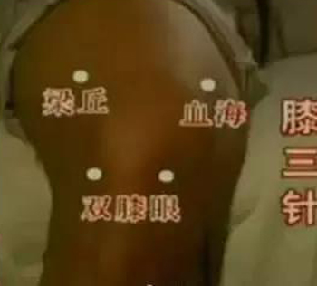 膝三针