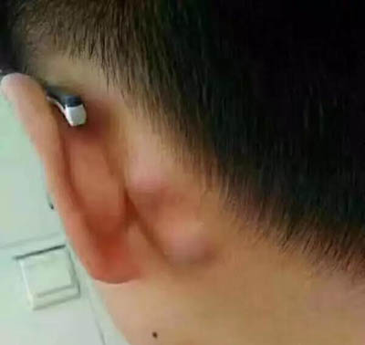淋巴肿大