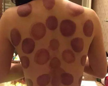 拔罐