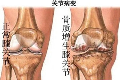 骨质增生