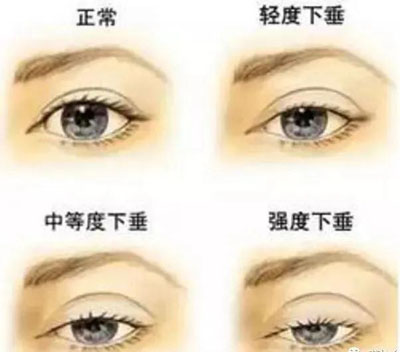 眼睑下垂