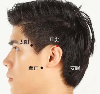 耳尖放血疗法
