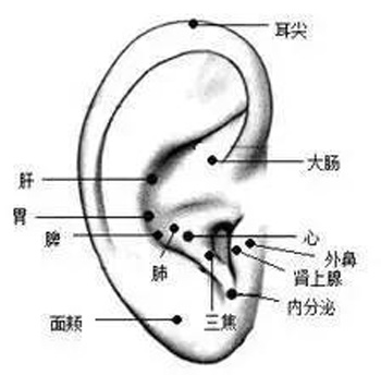 耳尖放血疗法