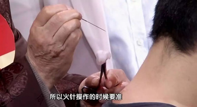 绝骨穴