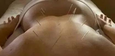 针灸