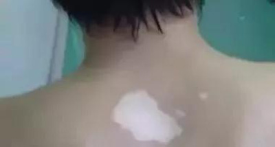 白癜风