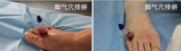 排瘀方法