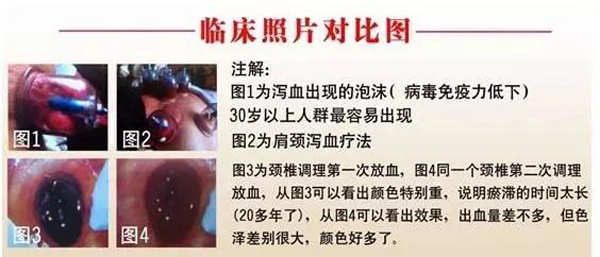 排瘀临床照片对比图