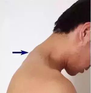 第7颈椎棘突