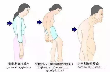 后凸畸形