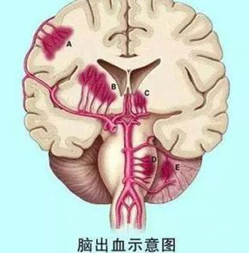 脑出血