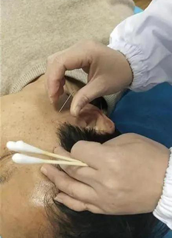 针灸