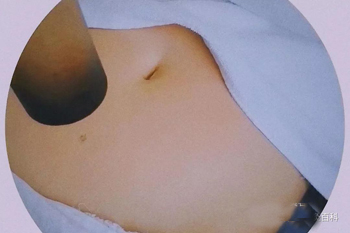艾灸