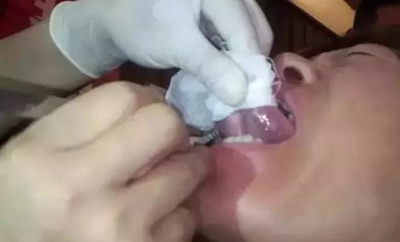 舌下刺血