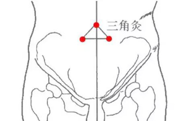 三角灸