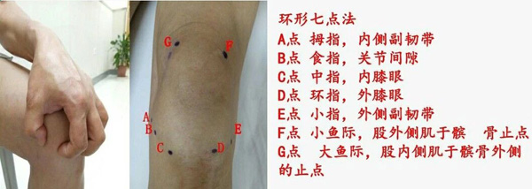 膝关节骨性关节炎的治疗