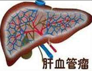 肝血管瘤