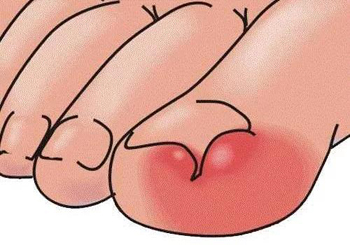 甲沟炎的中医外冶法