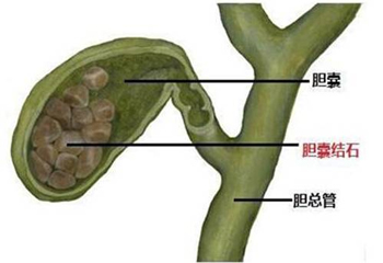 中医大师治疗胆结石秘方