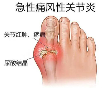 刺血治疗痛风