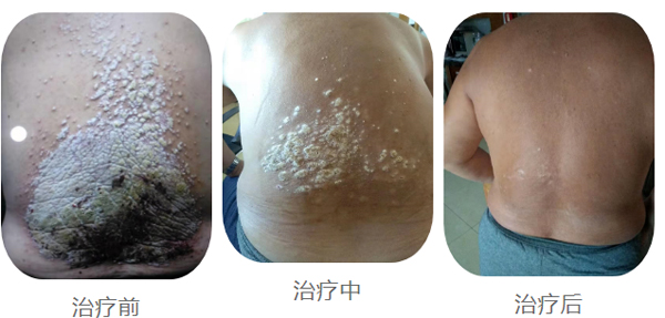 治疗银屑病，关节炎