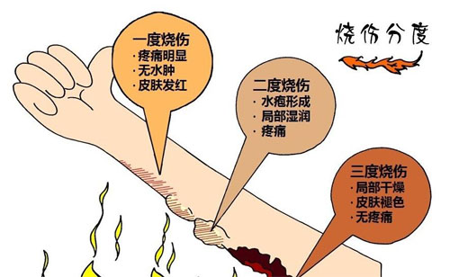 烫伤