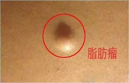 脂肪瘤