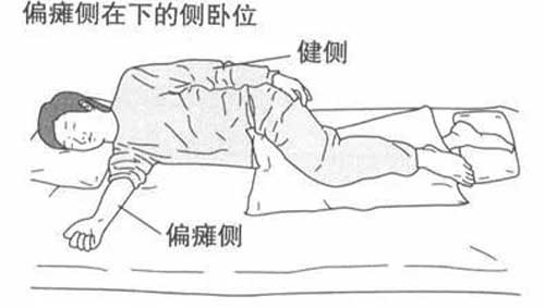 针灸治疗中风后遗症经验
