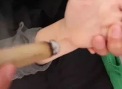 艾灸治湿疹验案