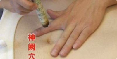 艾灸治疗急症两则