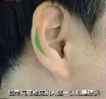 治颈椎的点穴绝技