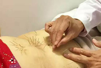 腹针的针刺手法