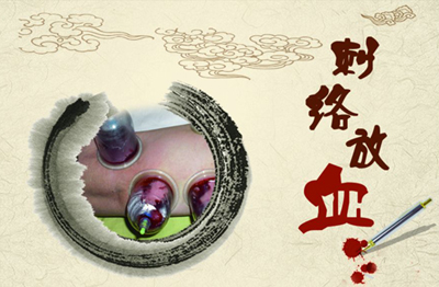 带状疱疹的针灸方法